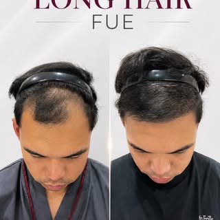 10-day Long Hair FUE result✨

An early look at the healing process and natural hairline restoration 