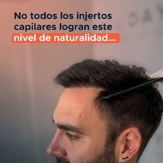 Cuando hablamos de injerto capilar, muchas personas piensan que todos los resultados son iguales, pe
