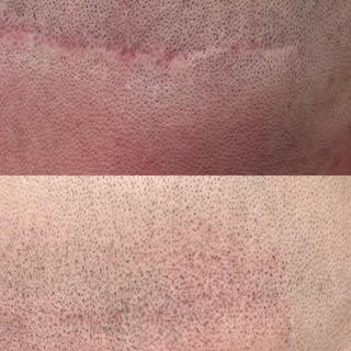 Just finished this Scar Camouflage from a hair transplant! Redness and impressions will continue to 