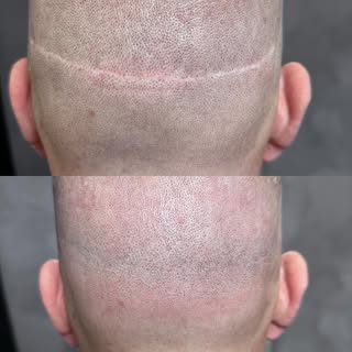 SMP inside another hair transplant scar. Our goal is always 80% camouflage, personally, this one is 