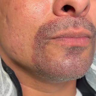 Beard Micropigmentation for the win. Added some more density through his goatee!