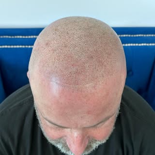 Natural. Fully customized to your face. Any level of loss. Swipe for before.
