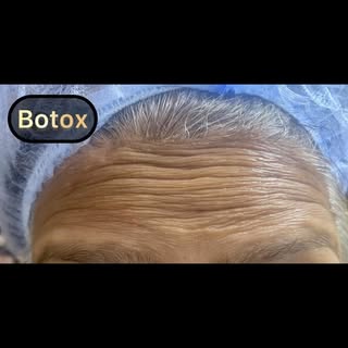 ✨ Smooth. Refreshed. Confident. ✨

Botox isn’t about changing who you are—it’s about enhancing your 