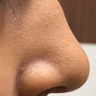Nose 👃 bridge contouring is a cosmetic procedure that uses dermal fillers to reshape and enhance th