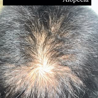 @drnavintaneja.dermatologist 
PRP (Platelet-Rich Plasma) therapy is a medical treatment that uses a 