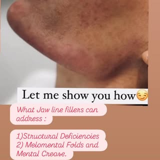 Jawline filler is a non-surgical cosmetic procedure to enhance definition and create a more sculpted