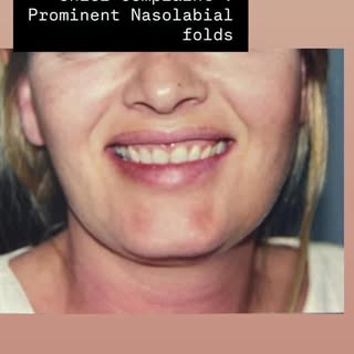 Here  Hyaluronic acid filler which can be used to relax muscles around the mouth, potentially reduci