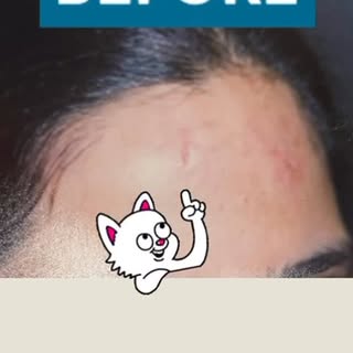 Good Riddance of Your Scars
At the National Skin Centre 
Depending on the scar depth,size and shape 