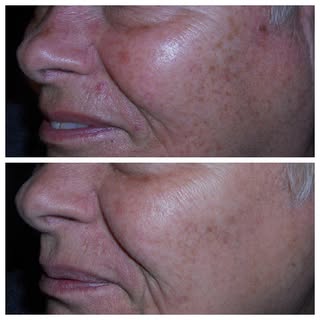 Now you see it, now you don’t!
•
Pesky brown spots (also known as solar lentigines) and broken blood