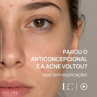 Muitas mulheres são surpreendidas por uma piora da acne depois de suspender o anticoncepcional.

E, 
