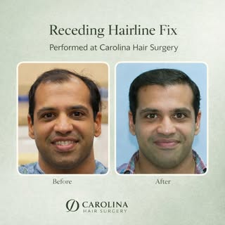 Receding hairline fix ✅

A natural, well-defined hairline restored with careful planning and precisi