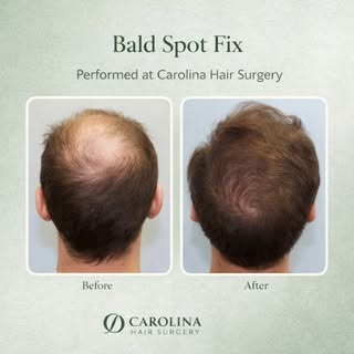 Bald Spot Fix ✅

A thinning crown restored with natural density and careful graft placement.
Perform