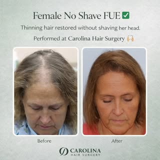 Female No Shave FUE ✅

Yes, we operate on women.

We also offer No Shave FUE for both men and women!