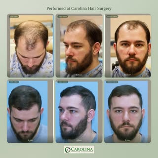 Three angles. One transformation... ✂️

Crown, side profile and front. This patient walked in with s
