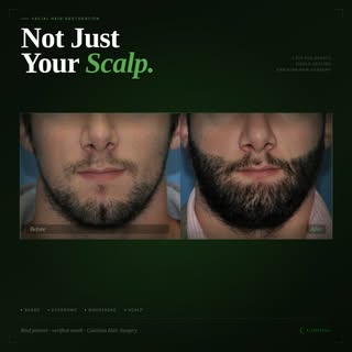 Beard transplants are one of the most requested procedures at Carolina Hair Surgery & the results sp