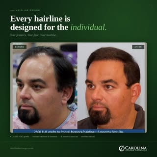 A natural hairline is never copied from a template. It's designed. Before Dr. Vories places a single