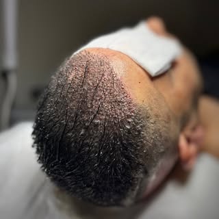 🌟DHI Tekniği ile Tıraşsız Saç Ekimi🌟

DHI (Direct Hair Implantation) Bu teknikte, saçlarınıza hiçb