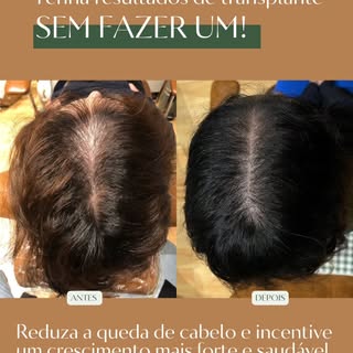 Durante a Master Consultation avaliamos:

• Histórico clínico
• Padrão de queda
• Saúde do couro cab