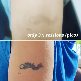 #tattooremoval #tattooremovalspecialists #hull #eastyorkshire