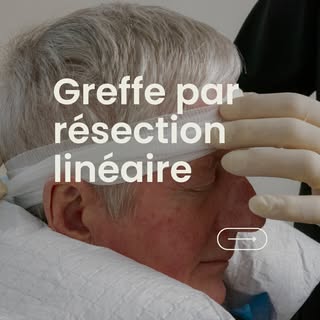 🔬 La greffe par résection linéaire : une solution efficace et durable

Cette technique permet de pr