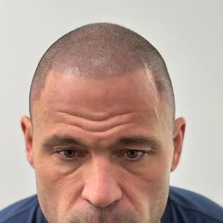 A fuller look. A stronger you. Scalp Micropigmentation changes everything.

Book your consultation t