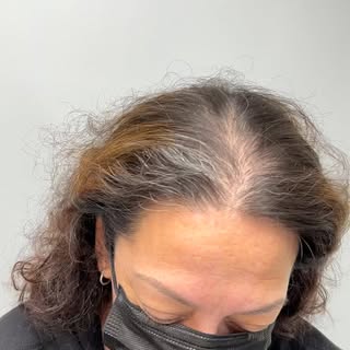 Thinning doesn’t mean settling.
Scalp Micropigmentation can create the look of fuller, denser hair—d