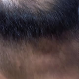 #hairpatchdelhi #hairtransformation #hairpatch #hairwigs #realhairwigs