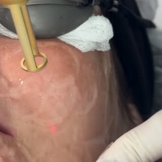 Tratando melasma

O laser é uma das ferramentas que utilizamos no tratamento do melasma.
Mas ele nun