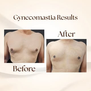 From self-conscious to confident 💪
A gynecomastia transformation that truly speaks for itself. 🌟

