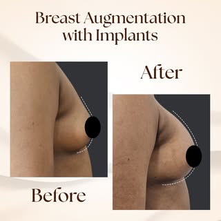 This before and after showcases breast augmentation with implants focused on enhancing shape, balanc