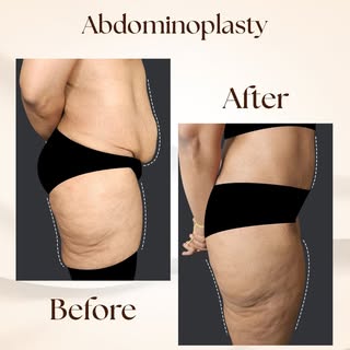 A smoother, firmer abdomen isn’t just about appearance—it’s about feeling more comfortable and confi