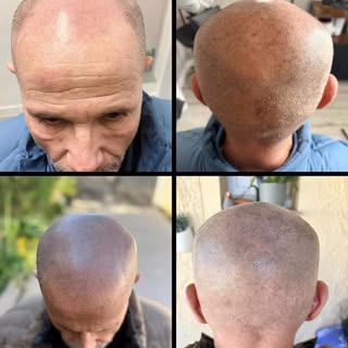 Effet rasé ultra réaliste 🔥

Une densité parfaitement maîtrisée,
une implantation naturelle,
et sur