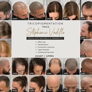 ✨ La tricopigmentation, bien plus qu’un simple changement esthétique…
C’est retrouver confiance, se 