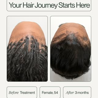 Edge(s) of Glory! 3 months of treatment, one happy hairline.⁠
⁠
Book your free consultation today an
