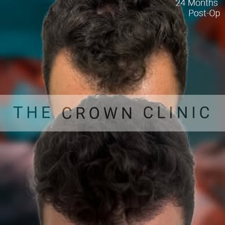 A beautiful 2300 graft FUE result at Crown Clinic is proof that smart planning beats chasing numbers
