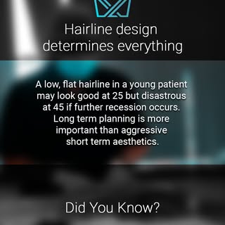 Hairline design determines everything because it frames the face and sets the foundation for how nat
