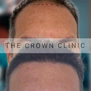 A 3,000 graft FUE can achieve a dramatic boost in density and coverage, and this result showcases th