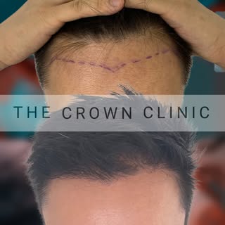 Another solid result from the Crown Clinic technical team. Just clean extraction, natural placement,