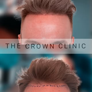 12 months. 1500 grafts. One confident transformation 🙌✨ ⁠
⁠
This patient’s journey shows just how n