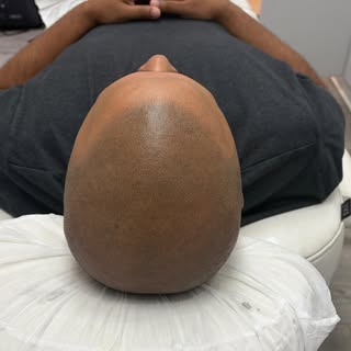 Another Scalpology transformation. Going from a Norwood 7 to a full hairline buzz cut!! 
#hairline #