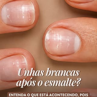 Você tirou o esmalte e as unhas estavam brancas e esfarelando. A primeira coisa que vem à cabeça: “D