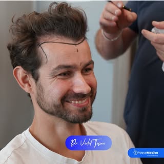 Patient Experience! 🤩
.
.
.
.
.
.
.
.
#hairtransplant #fuehairtransplant #hairtransplantistanbul #h