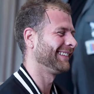 Patient Experience! 🤩
.
.
.
.
.
.
.
.
#hairtransplant #fuehairtransplant #hairtransplantistanbul #h