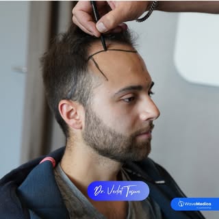 Patient Transformation Begins! 🤩 
.
.
.
.
.
.
.
.
#hairtransplant #fuehairtransplant #hairtransplan