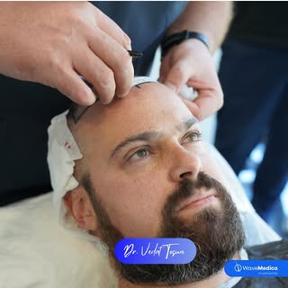 Patient Experience! 🤩
.
.
.
.
.
.
.
.
#hairtransplant #fuehairtransplant #hairtransplantistanbul #h