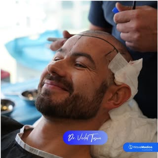 Patient Transformation Begins! 🤩 
.
.
.
.
.
.
.
.
#hairtransplant #fuehairtransplant #hairtransplan