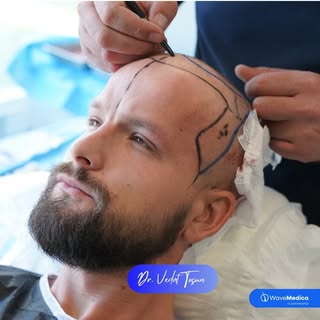 Patient Transformation Begins! 🤩 
.
.
.
.
.
.
.
.
#hairtransplant #fuehairtransplant #hairtransplan