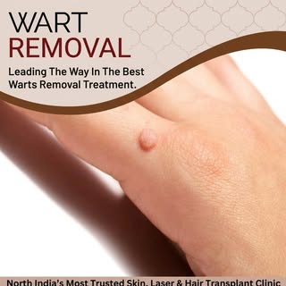 ✨ Say goodbye to stubborn, unwanted bumps and hello to smooth, clear skin! 🛑🔍 Wart removal is a sa