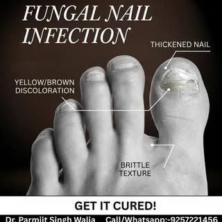 ✨ Step into confidence and say goodbye to stubborn, discolored, or brittle nails! 🛑🦶🏽 Fungal nail