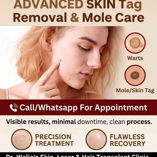 ✨ Clear, smooth, and worry-free skin is just a quick visit away! 🛑🔍 Skin tag and mole removal is a